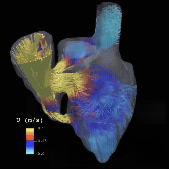 Simulación CFD de flujo cardiovascular mostrando líneas de corriente de velocidad