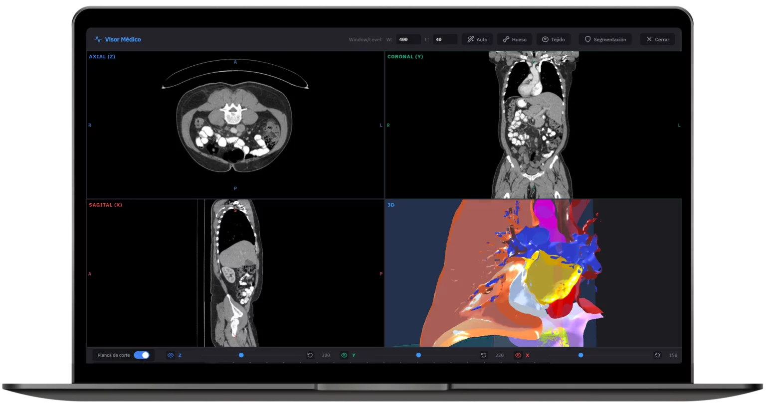 Interfaz de la plataforma médica Nexus con un gemelo digital tridimensional del corazón para planificación en cardiología