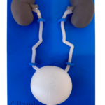 Ureteral Stone Simulator